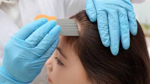 Los CDC cambian sus normas sobre los piojos y las escuelas